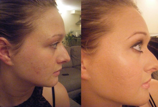 Kem nền Clinique Acne Solutions Liquid Makeup – Không gây mụn cho làn da dầu, nhạy cảm