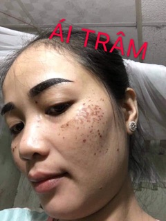 Chấm tàn nhang 7 ngày bong