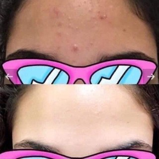 KEM A313 BẢN NỘI ĐỊA PHÁP (RETINOL A313)