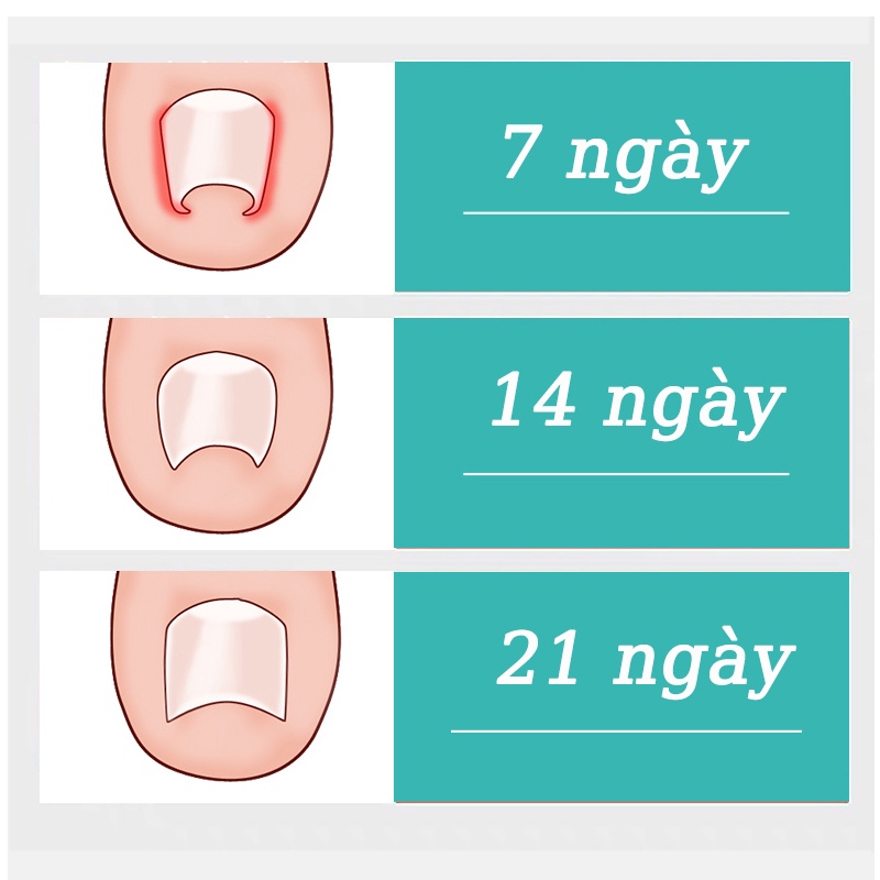Kem Dưỡng Móng Phục Hồi Móng Nấm 15g- Móng Hư Tổn Móng kháng khuẩn chân loại nấm móng gãy móng chống các bệnh nấm móng nhanh dùng nam và nữ Móng kháng khuẩn
