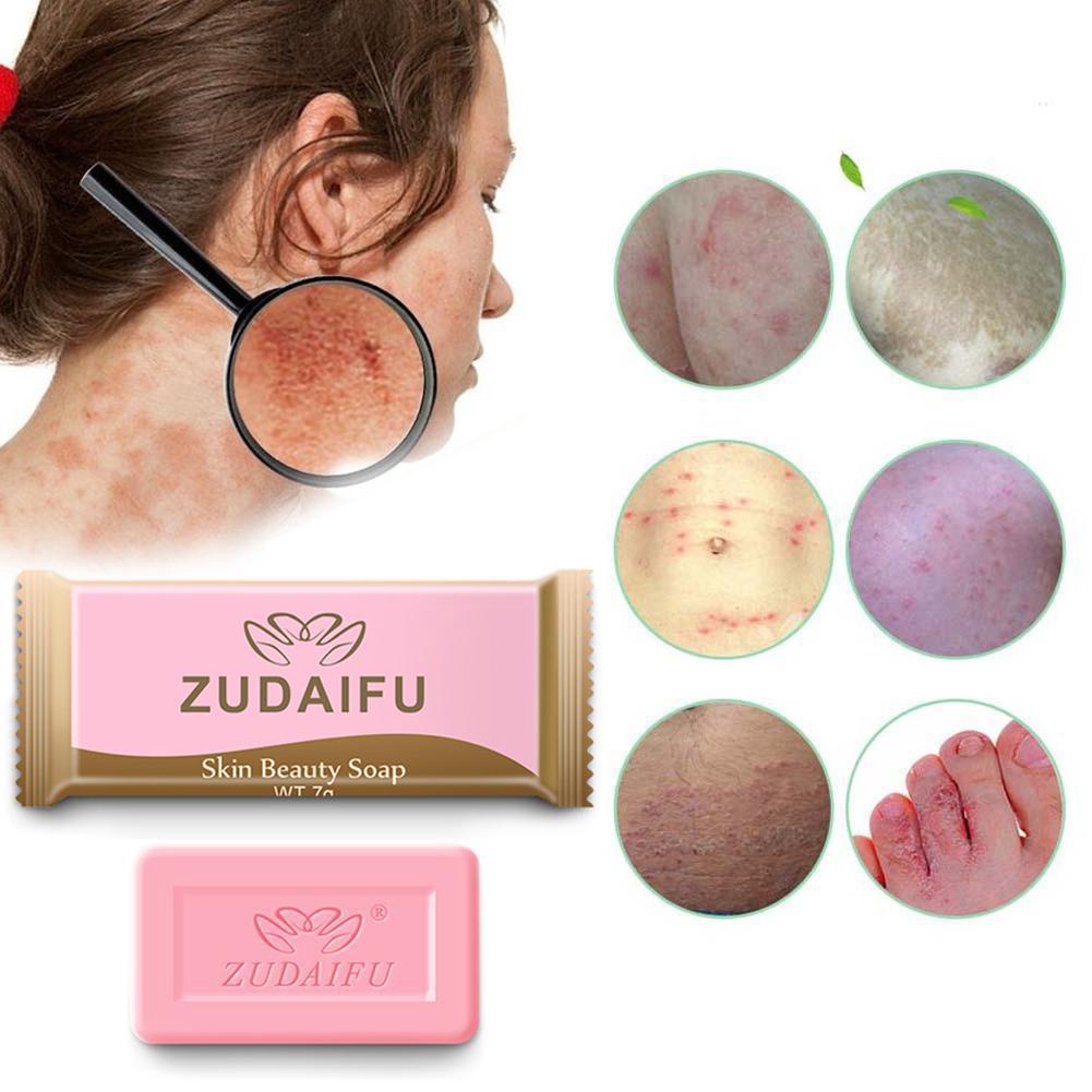 (Hàng Mới Về) Xà Phòng Sulfur Zudaifu Trị Mụn / Chống Vẩy Nến / Dầu Gội Cho Nhà Tắm G4D0