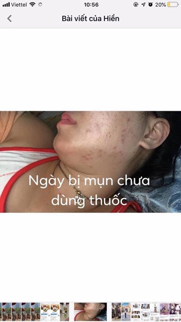 KEM MỤN BAI CAO JI giảm mụn, giảm nhờn, kiềm dầu 10g | BigBuy360 - bigbuy360.vn