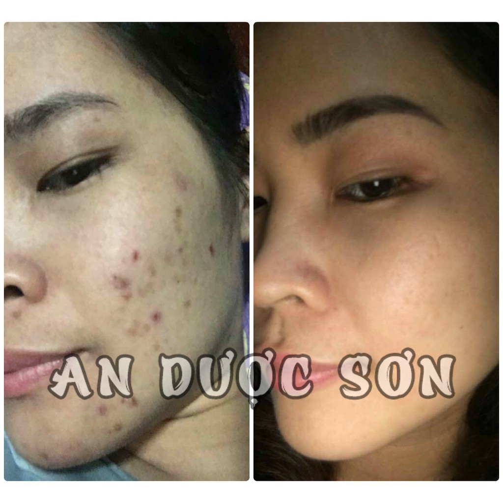 Combo Serum tái tạo bong da 30ml và Bột Thảo Dược