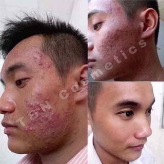 Serum diếp cá Igreen