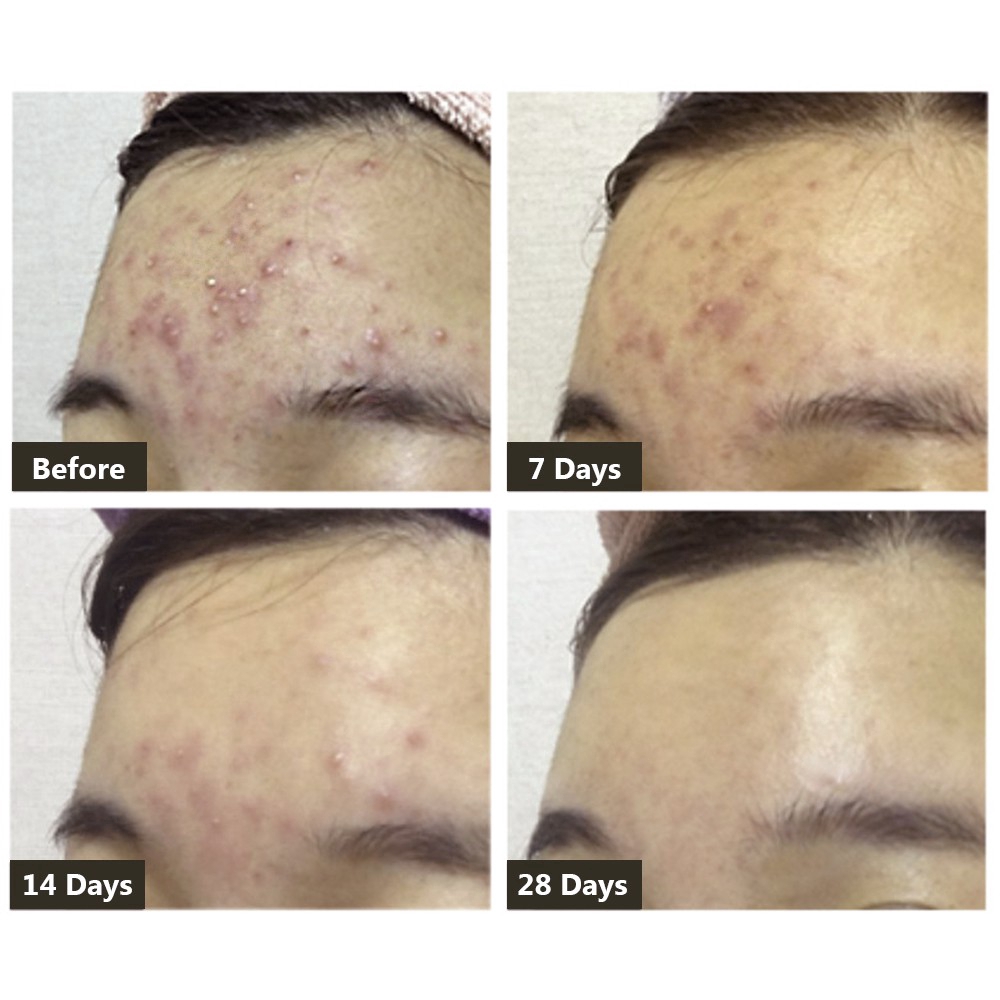 Serum hỗ trợ giảm Mụn BREYLEE 17ML+Kem hỗ trợ giảm Mụn Breylee 20g