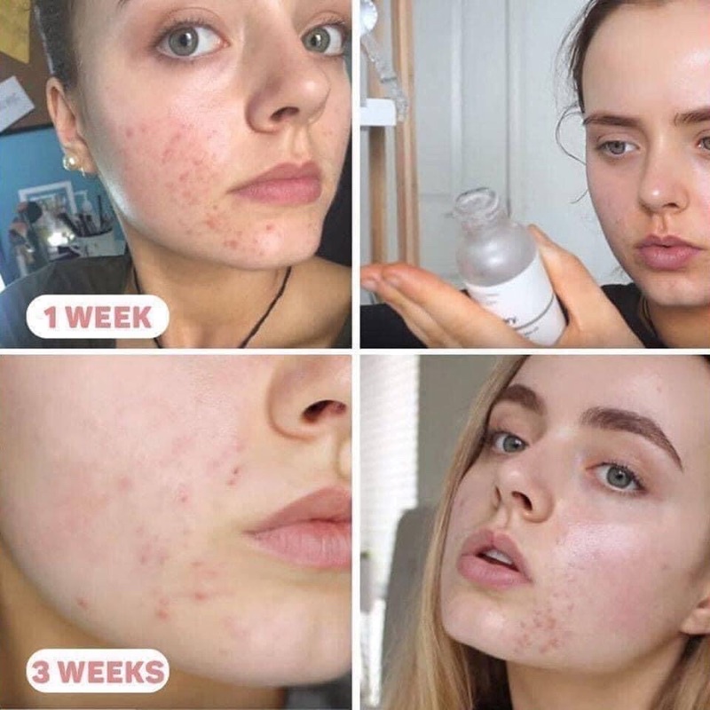 Serum The Ordinary Niacinamide 10% + Zinc 1% 30ml
