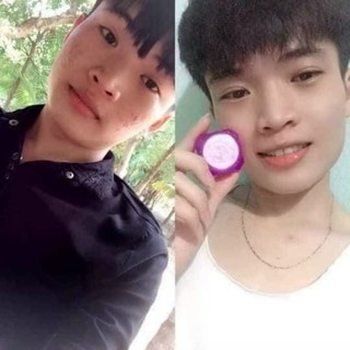 combo 5 hộp face mụn( mua 10hộp tặng 1 hộp)
