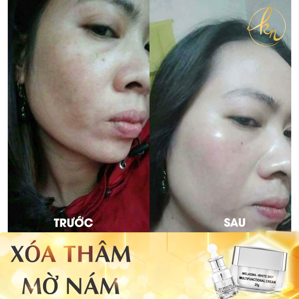 Bộ sản phẩm dưỡng da ngừa nám tàn nhang được Thúy Nga tin dùng hiệu quả hơn mong đợi