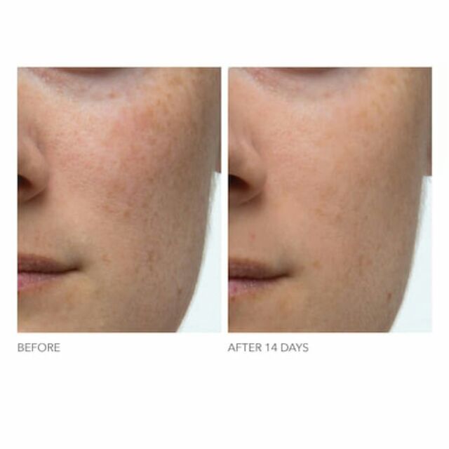 Bộ peel da Dr Dennis Gross Extra Strength Daily Peel