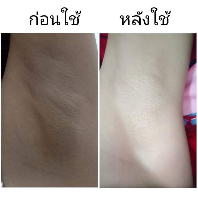 Kem dưỡng thâm nách, thâm mông bikini, rạn da Pure Thái Lan Chính Hãng 50g Hot TikTok