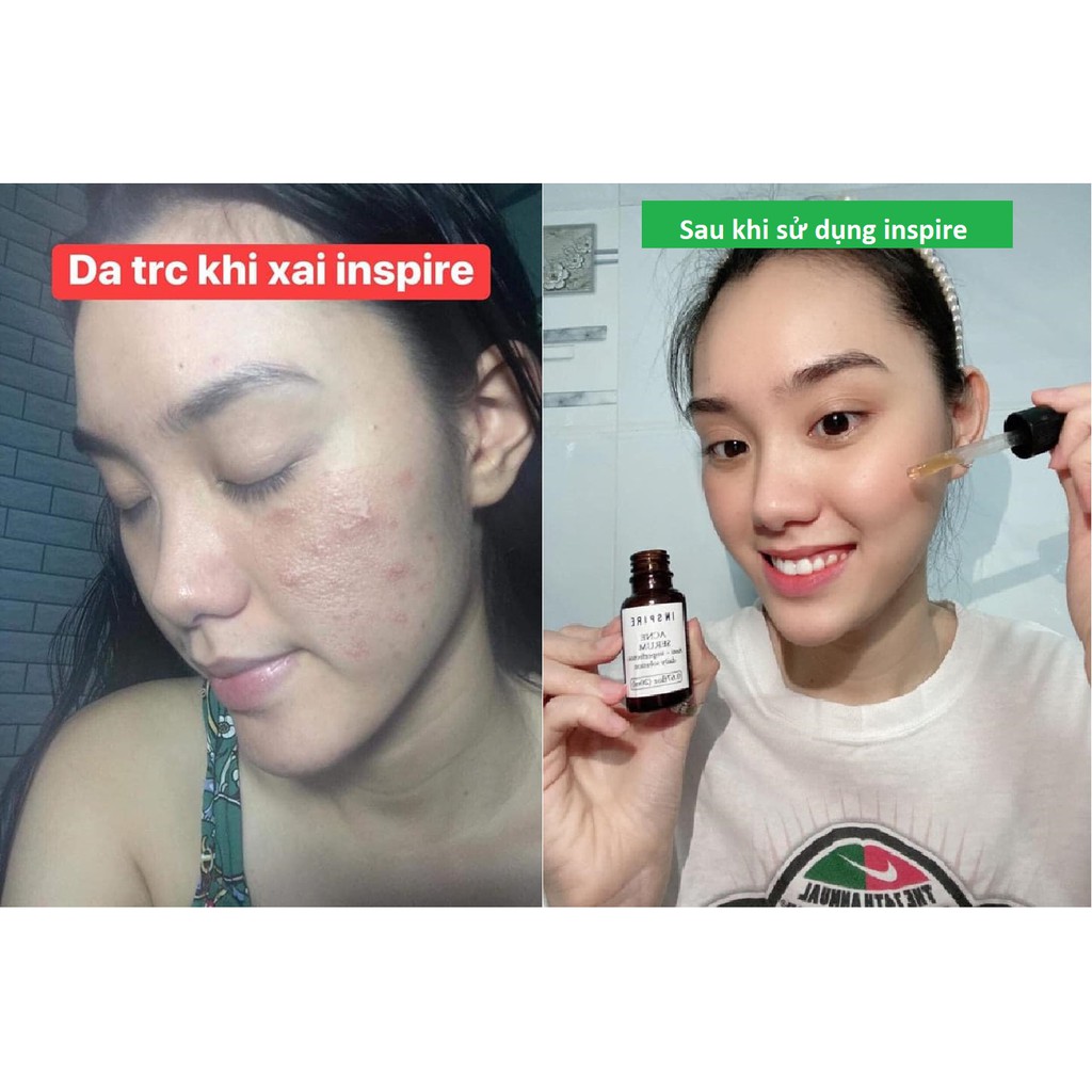 Serum Ngừa Mụn INSPIRE Acne Serum Sạch Mụn, Sáng Da 15ml