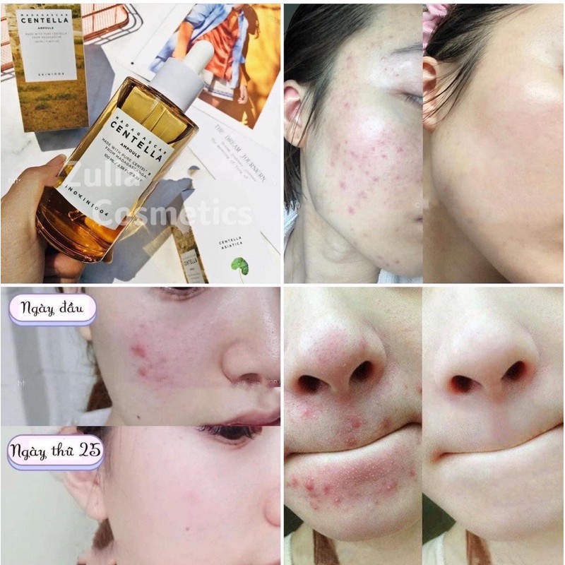 [FREE SHIP] SKIN1004 Serum Tinh chất Rau má Giảm Mụn thâm phục hồi da Madagascar