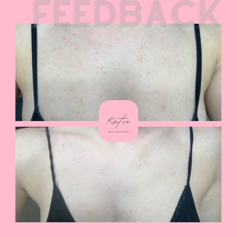 COMBO Cải thiện thâm mông, body - BODY ACNES COMBO | KATIEBEAUTY