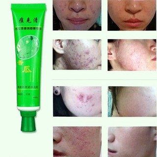 30g Acne cream blain products desalt blain remove imprint face cream skin care