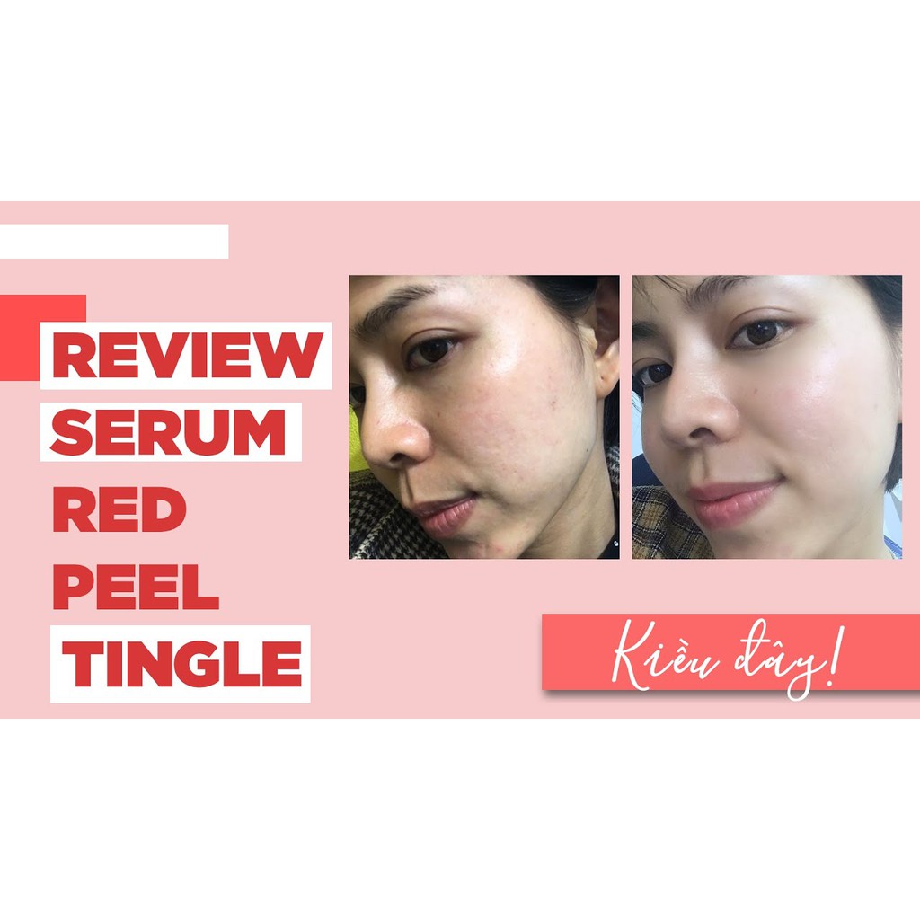 [Mẫu Mới] Tinh Chất Serum RED PEEL Tái Tạo và Phục Hồi Da Tingle Serum So Natural 35ml | BigBuy360 - bigbuy360.vn
