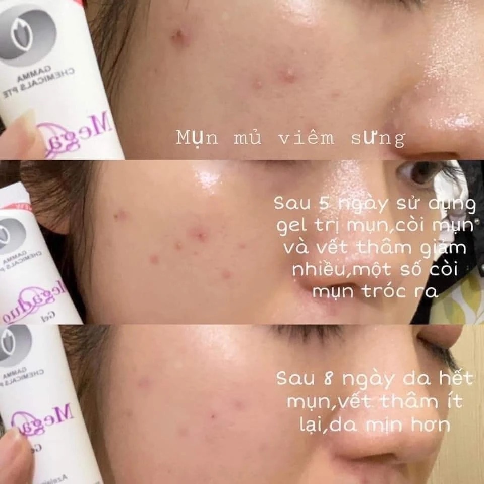 Gel Giảm Mụn Ẩn Và Thâm Gamma Megaduo Gel 15g - Bản Plus