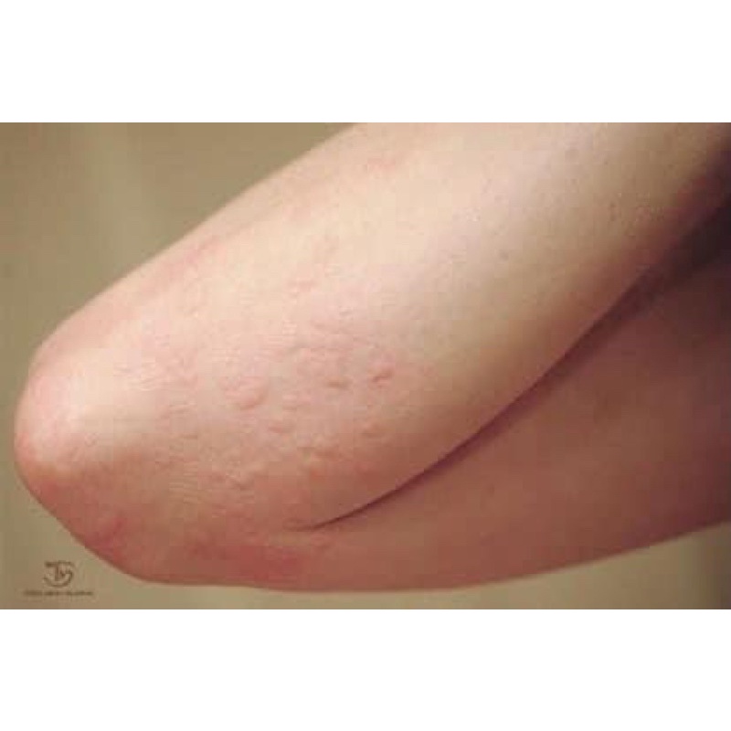 Cardramine -v giảm mẫn ngứa thái lan