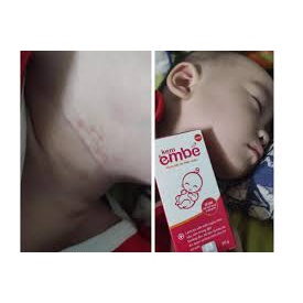 Kem Em Bé dưỡng ẩm da mờ sẹo ngừa thâm viêm da cơ địa muỗi đốt rôm sảy chàm sữa mẩn ngứa mát da rau má thảo dược kem hăm