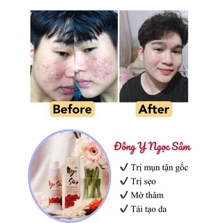 TINH CHẤT NGỌC SÂM NGỪA MỤN TRẮNG DA - 150ML