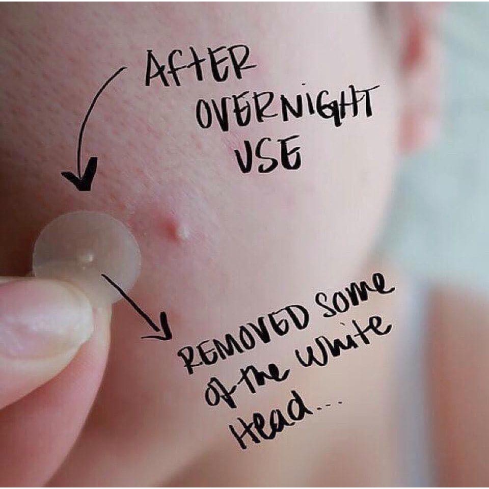 Miếng dán mụn Cosrx Acne Pimple Master Patch