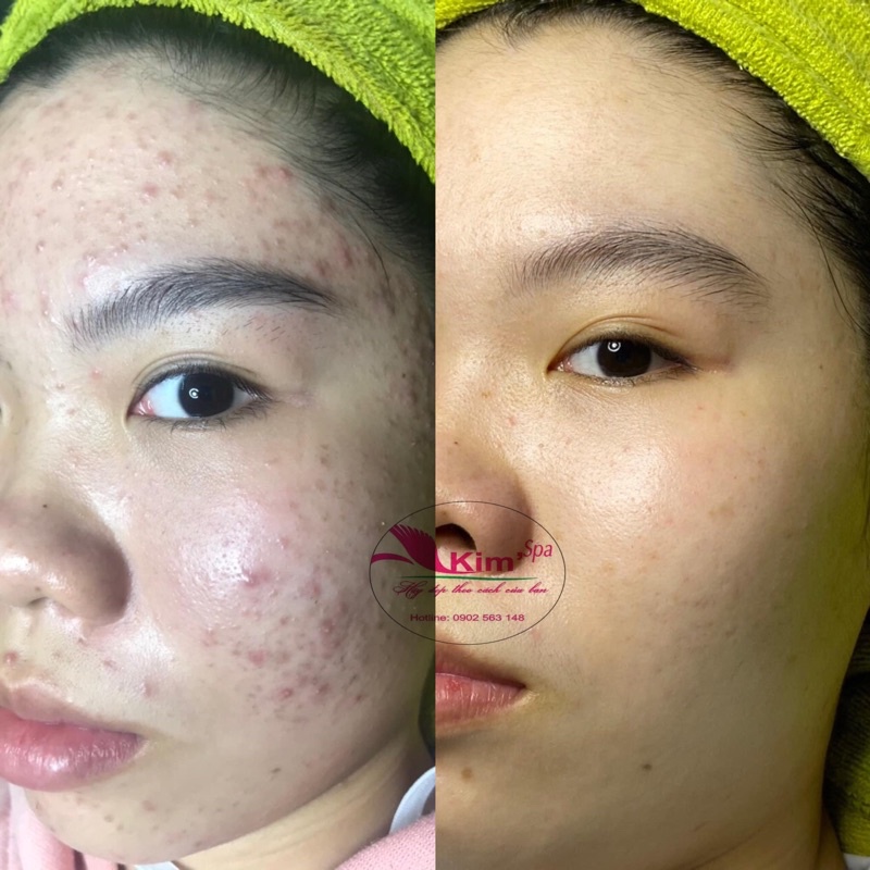 Kem Tái Tạo Da Đông Y Tái Tạo Da Mặt Hiệu Quả Xóa Tan Mụn Nám Tàn Nhang Dành Cho Bạn