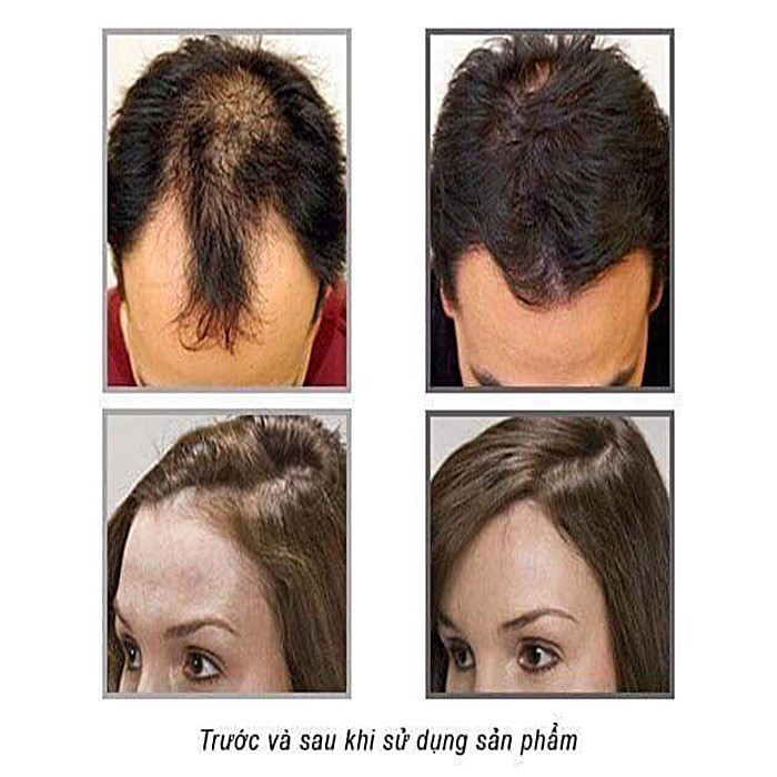 DẦU GỘI-XẢ TRỊ RỤNG TÓC KAMINOMOTO MEDICATED HAIR