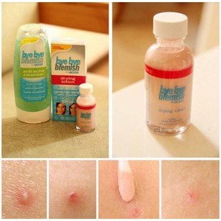 LOTION CHẤM MỤN BYE BYE BLEMISH