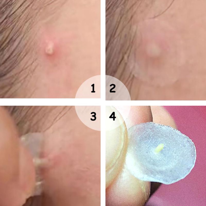 Set 36 Miếng Dán Mặt Trong Suốt Chống Nước Thoáng Khí Tiện Dụng