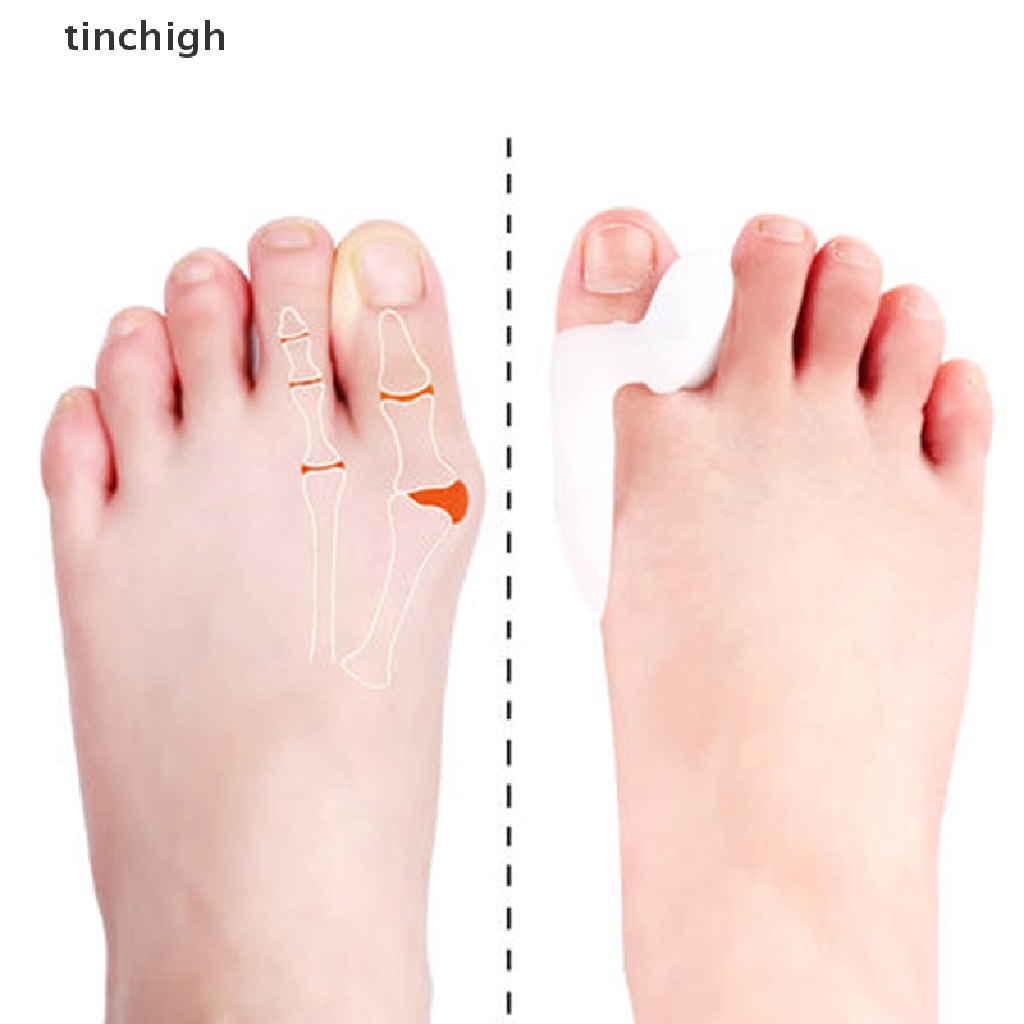 Set 2 Dụng Cụ Silicone Định Hình Ngón Chân Cái Giảm Đau