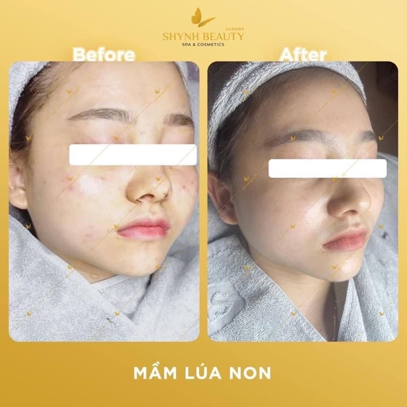 MẦM LÚA NON MỤN 50ml❤️ - Shynh Beauty