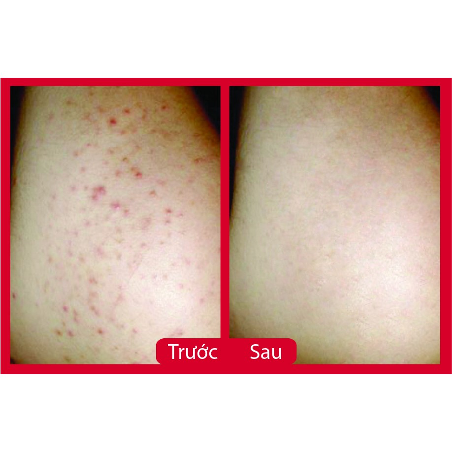 SERUM Thâm Mụn -Thâm Do Côn Trùng Đốt - Thâm Chân Tay - Nách- Bẹn | BigBuy360 - bigbuy360.vn