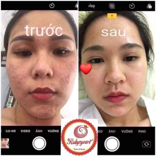 BAY MỤN RubyCare