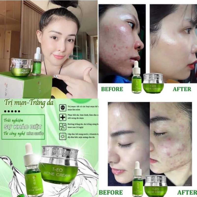 BỘ T-EO ACNE CREAM DƯỠNG DA