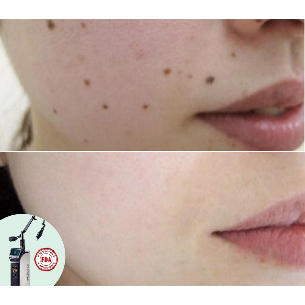 HCM  Xóa nốt ruồi không để lại sẹo, không đau với công nghệ Fractional Co2