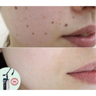 HCM [Voucher Giấy] Xóa nốt ruồi không để lại sẹo, không đau với công nghệ Fractional Co2