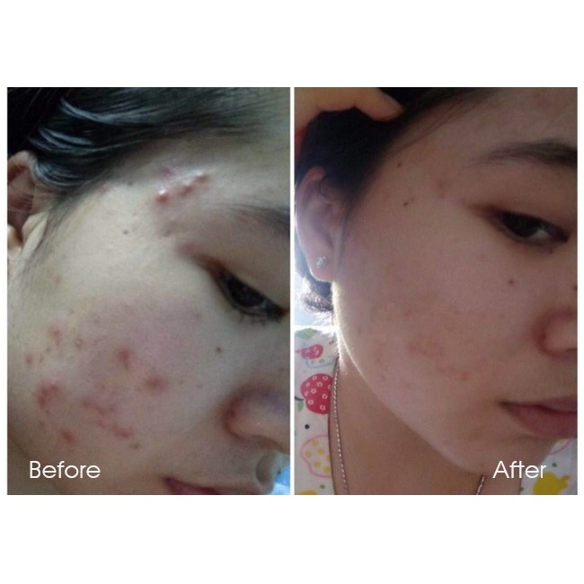 Benzoyl Peroxide: Diệt Khuẩn,Ức Chế Sự Nhân Lên Của Vi Khuẩn C.Acnes