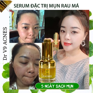 Serum giảm mụn V9Queen, tinh chất rau má giúp mờ thâm mụn se khít lỗ chân lông