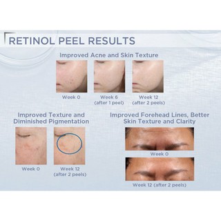 Dung dịch peel da Neostrata Prosystem Retinol Peel