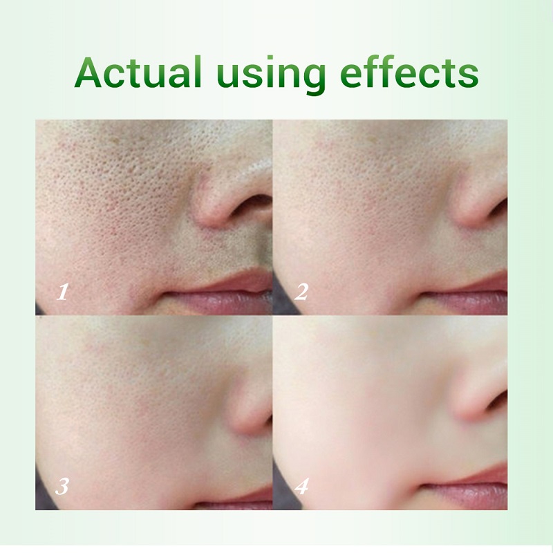 Kem Axit Salicylic 20ml Se Khít Lỗ Chân Lông Cải Thiện Mụn Đầu Đen Làm Trắng Kiềm Dầu Chống Lão Hóa