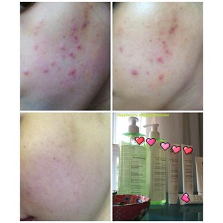 Sữa Rửa Mặt Da Mụn Sebiaclear Gel Moussant