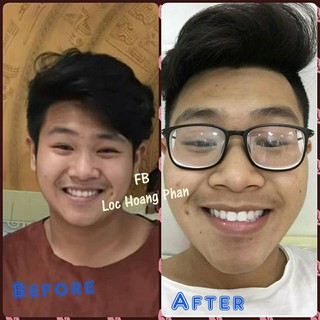 Liệu trình 21 ngày - Miếng dán trắng răng CREST WHITESTRIPS SUPREME PROFESSIONAL WHITENING