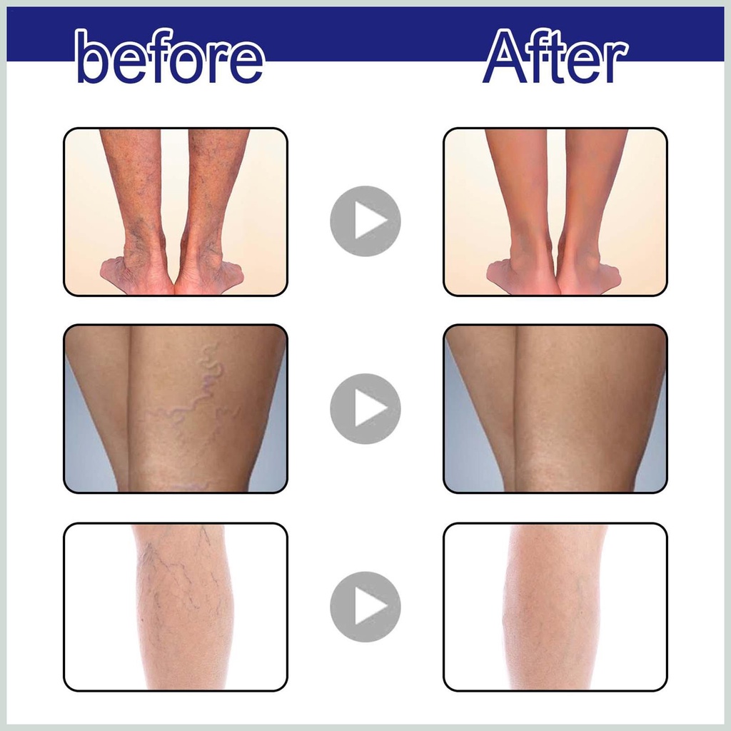 Thuốc Trị Giãn Tĩnh Mạch Chân 1.05oz