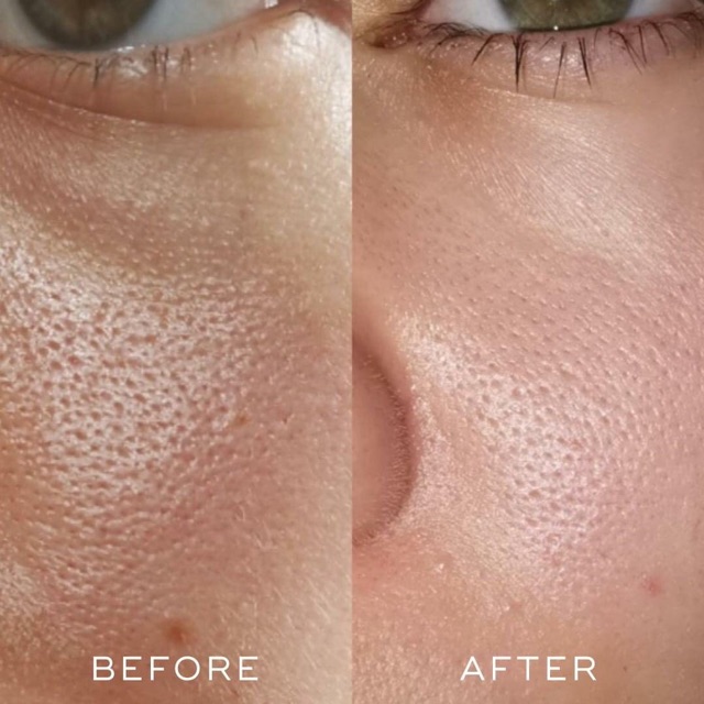 Nước hoa hồng Medik8 medik 8 pore minimising tonic toner acid - Chính hãng