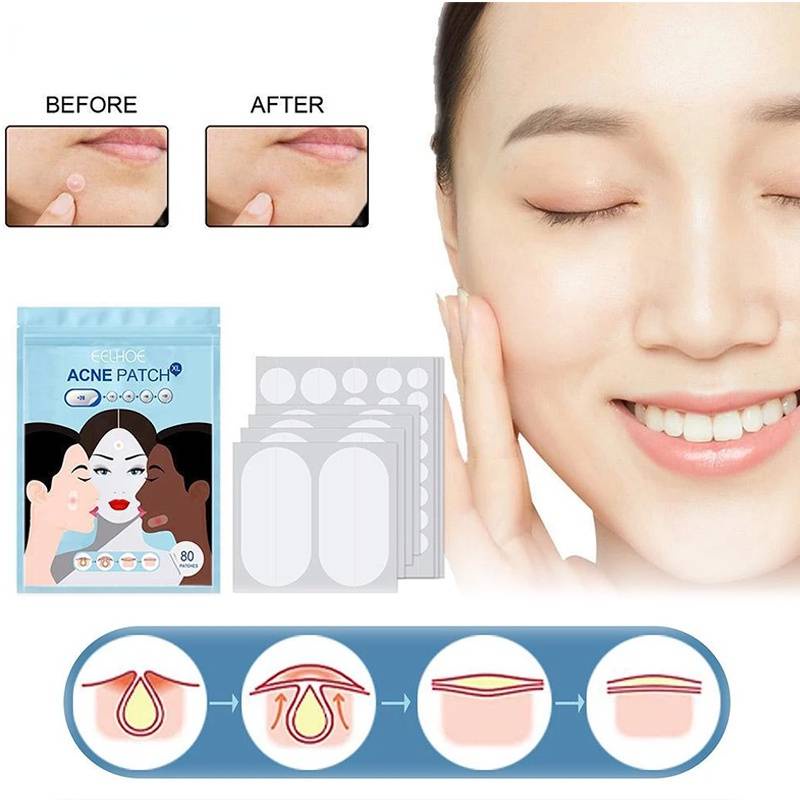 Set 80 Miếng Dán Hỗ trợ giảm mụn Đa Năng Nhanh Chóng Tiện Lợi