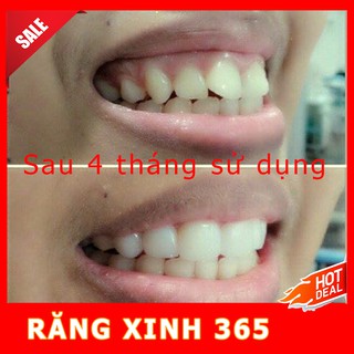 Niềng Răng Bí Mật ( Hàng Chính Hãng )