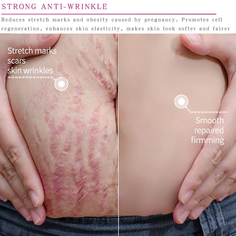 [Hàng mới về] Tuýp kem xoài tự nhiên trị rạn da hiệu Rtopr không gây kích ứng