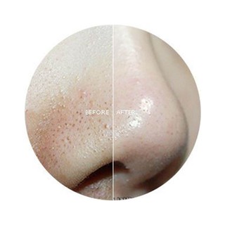 Miếng đẩy mụn Goodbye Blackhead - Tặng que nặn