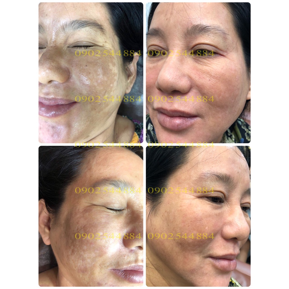 Serum nám Hoàng Trinh