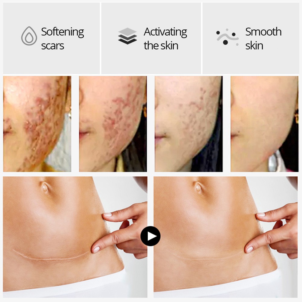 VIBRANT GLAMOUR Acne Scar Removal Serum Skin Repair Scar Essence Acne Treatment Cream Remove Stretch Marks Whitening Spots Reduce Appearance of Acne Scars, Marks, Wrinkles, and Dark Spots Shrink Pores Blackhead Skin Repair  15ml*4pcs