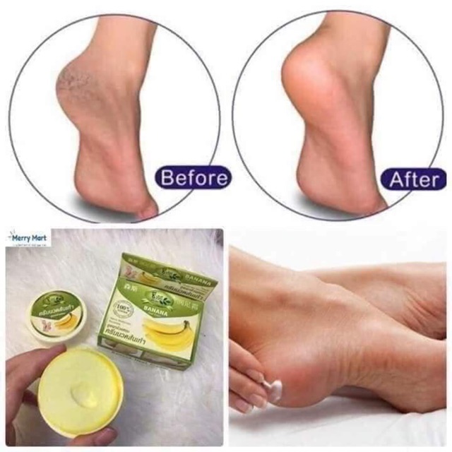 Kem trị nứt chân banana heel cream | BigBuy360 - bigbuy360.vn